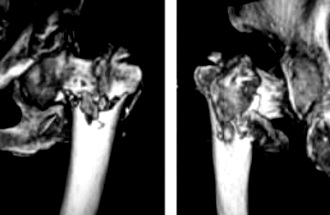 3D-CTを用いた簡便な大腿骨転子部骨折分類の提案