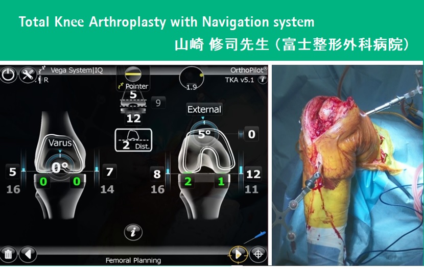 OrthoPilot TKA Navigation system ～Tibia first with soft tisue management～