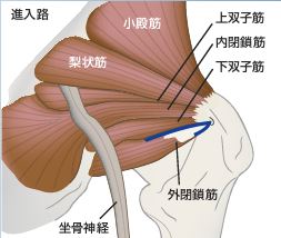Conjoined tendon Preserving Posterior approach 共同腱温存アプローチ手術手技書