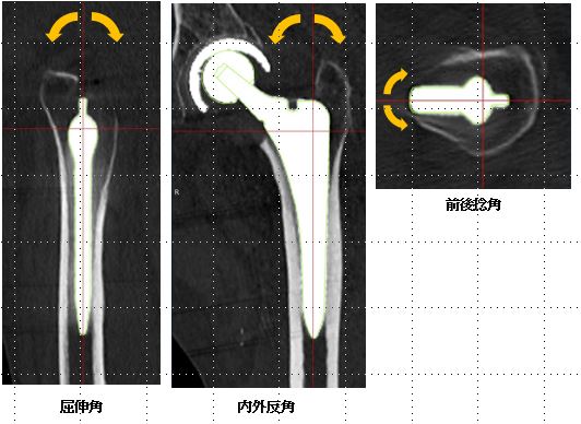 短外旋筋共同腱温存後方（CPP） アプローチによる人工骨頭挿入術においてステムは計画通りのアライメントで挿入可能である